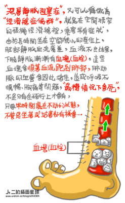高抬貴腿-深層靜脈栓塞症01.gif