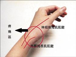 媽媽手是因為手腕拇指側的支持帶出現增厚現象，壓迫到下方的肌腱（圖1）。（照片提供／謝絲安）
